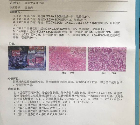 父亲53岁，得了印戒低分化，化不化疗好