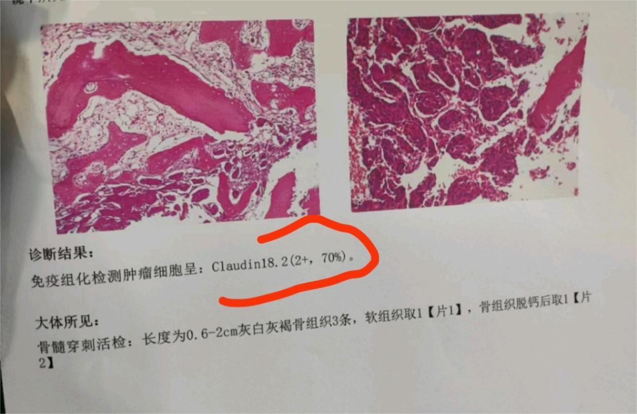 我爸胃癌骨转移骨髓转移，医院说没希望了，现在只有一个突变